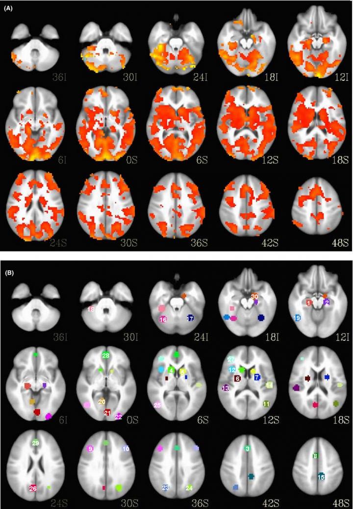 MRI Brain Scans