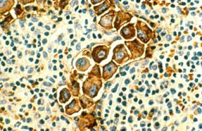 Breast Cancer in Lymph Nodes