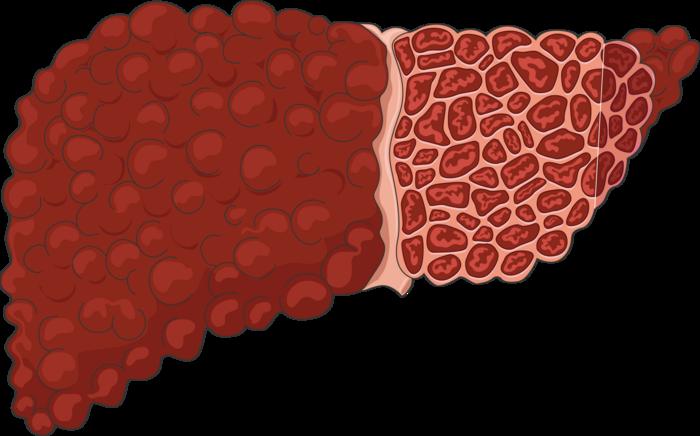 Study explores ultrasound-based method for assessing portal hypertension in cirrhosis