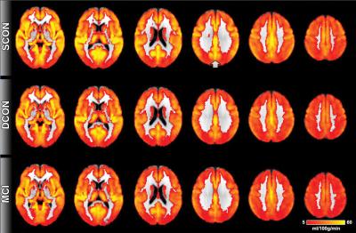 Brain Perfusion