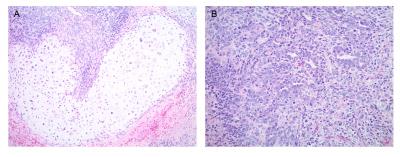 Researchers Find Genes Behind Aggressive Ovarian and Endometrial Cancers