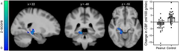 Insulin-induced changes in regional cerebral blood flow