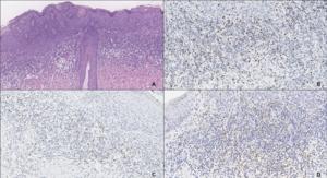PD-L1 and FOXP3 expression in high-grade squamous intraepithelial lesions of the anogenital region