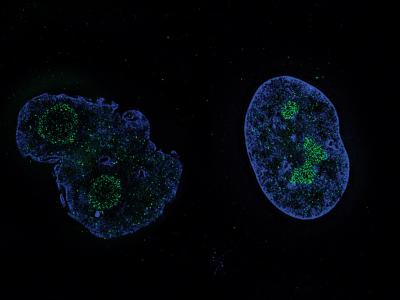 Remodelin to the Rescue of Nuclear Defects? (1 of 3)