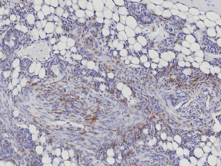 During Tumor Development