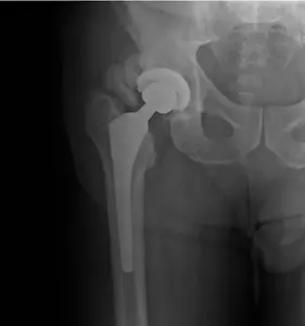Heterotopic ossification (HO) around a hip implant
