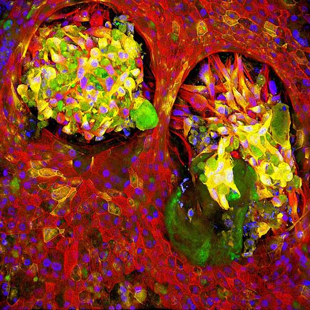 Lung cancer on a chip