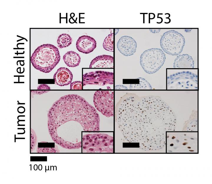 Healthy and Tumor Organoids