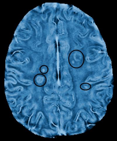MS Lesions