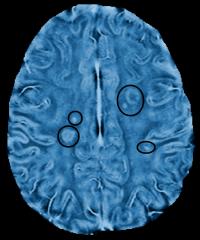MS Lesions