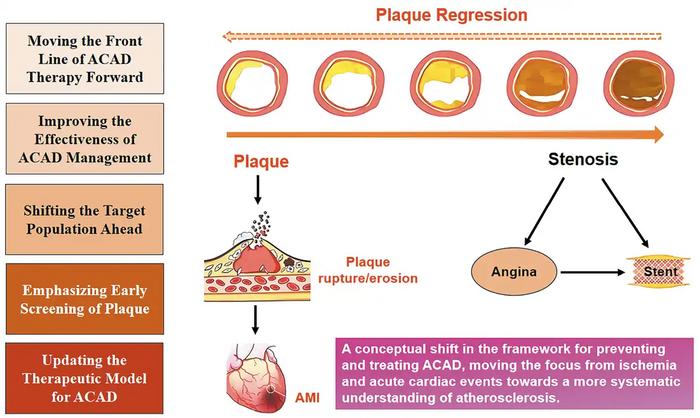 Atherosclerotic  Plaque or Coronary Stenosis: Which is the Real Driver?