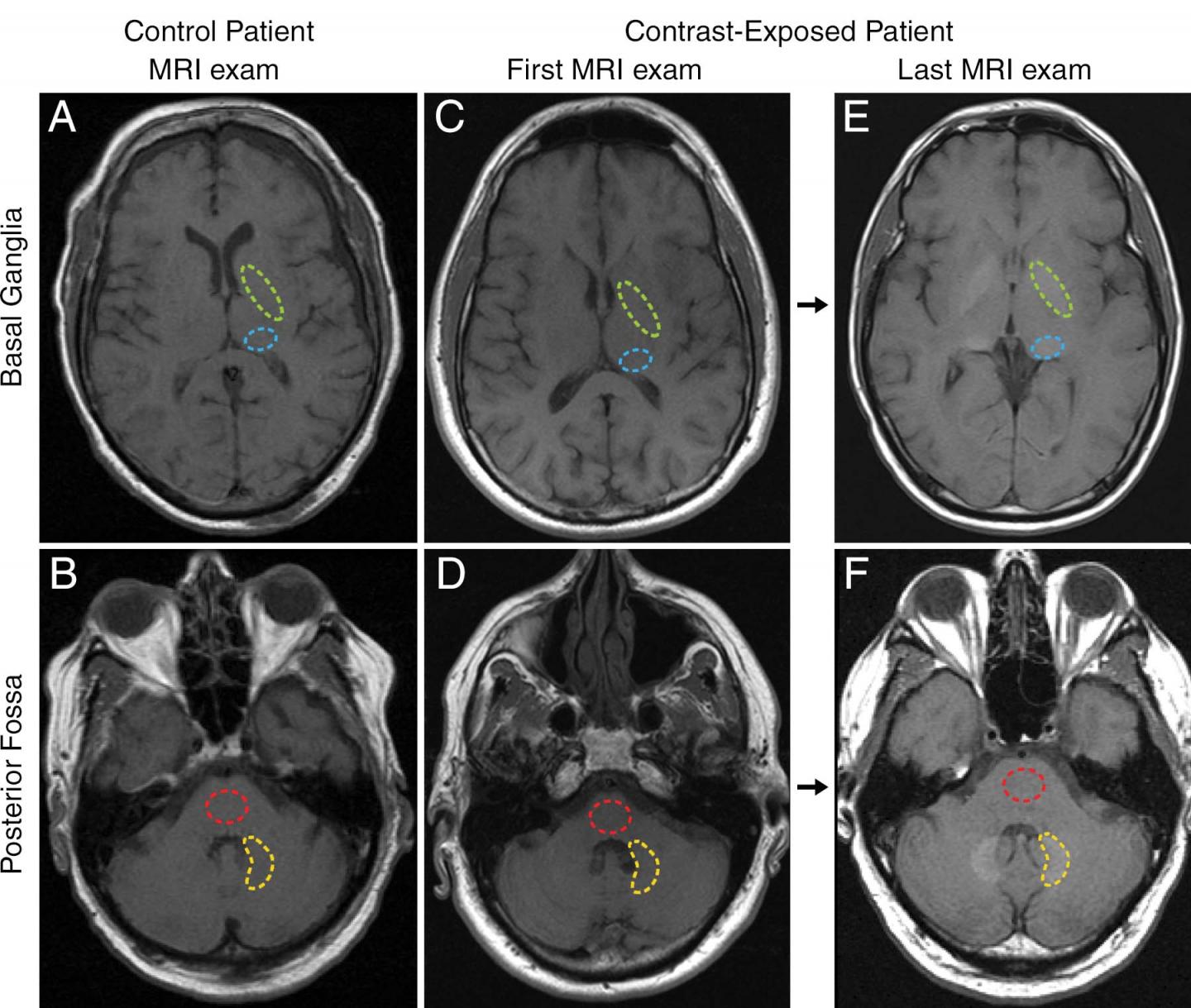 Study Finds No Evidence that Gadolinium Causes Neurologic Harm (1 of 3)