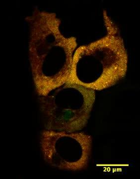 Stress Granules Linked to Metastasis