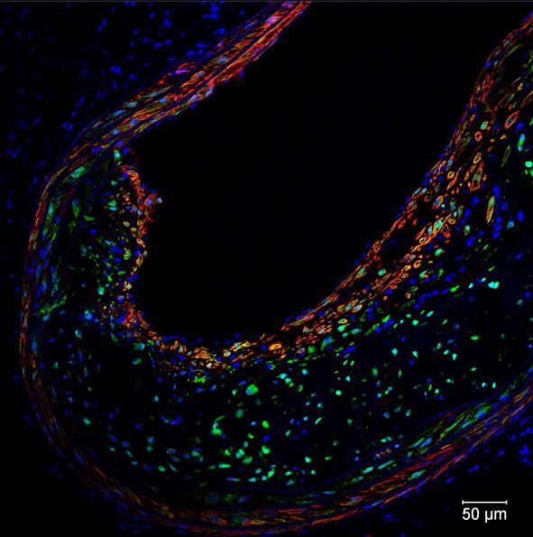 Potential 'fountain of Youth' Gene Helps Prevent Stroke, Heart Attacks