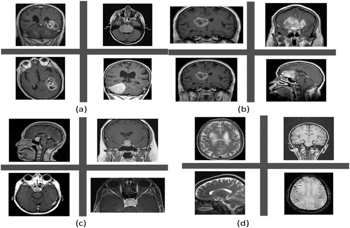 MRI scans of brain tumors