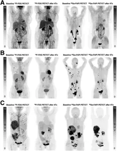 Maximum-intensity-projection images at baseline and follow-up 18F-FDG PET/CT and 68Ga-FAPI PET/CT.