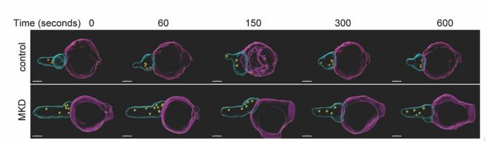 3D video frames of an MKD patient's impaired NK cells