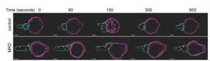 3D video frames of an MKD patient's impaired NK cells