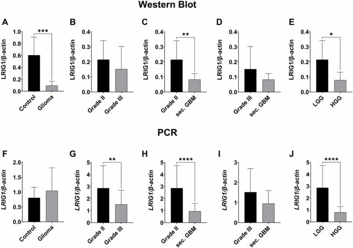LRIG1-3 in gliomas: LRIG1 protein expression decreased in higher grade gliomas