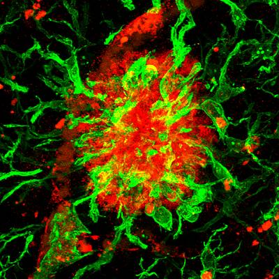 Amyloid Plaque Positive for SFRP1