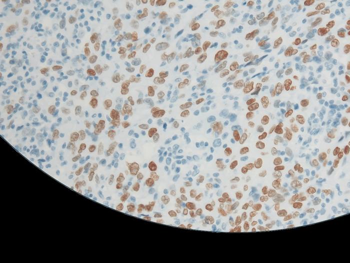 Understanding the potential contribution of germline pathogenic variants to lung cancer etiology