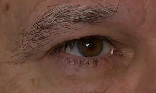 Bimatoprost Ring Fitted in Patient's Eye