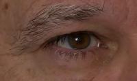 Bimatoprost Ring Fitted in Patient's Eye