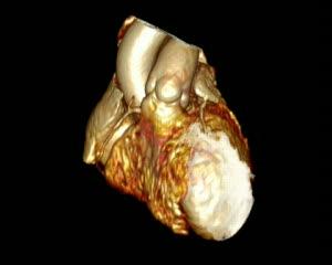 Cardiac Imaging Breakthrough