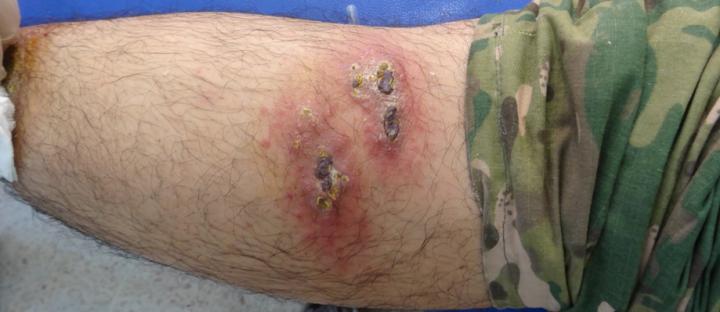 <i>Leishmaniasis</i> Strain in Iraq Outbreak Identified