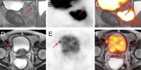 An Example of Local Staging of the Prostate with 68Ga-PSMA-11 PET/MR Imaging