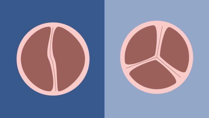Study Implicates Two Genetic Variants in Bicuspid Aortic Valve Development