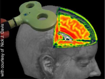Transcranial Magnetic Stimulation