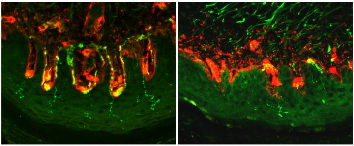 Normal vs Diabetic Skin