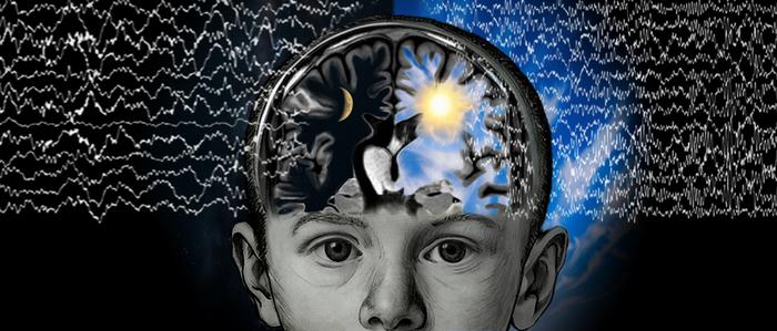 Disconnected cerebral hemisphere in epilepsy patients shows sleep-like state during wakefulness