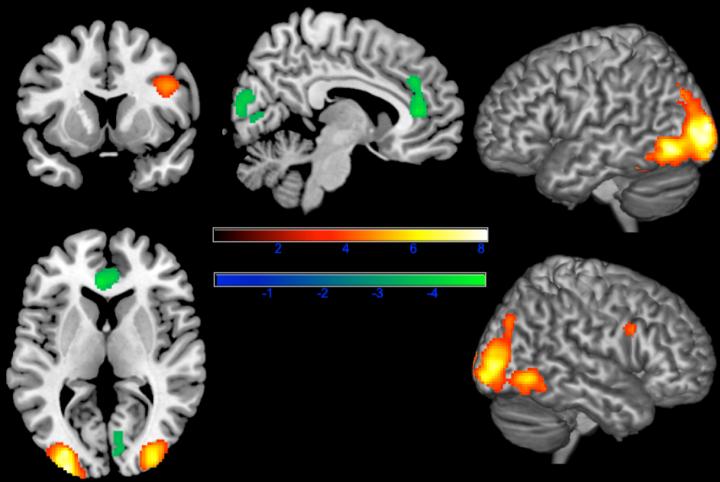 Neural Responses to Facial Disfigurement