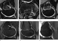 Irregular Findings Common in Knees of Young Competitive Alpine Skiers