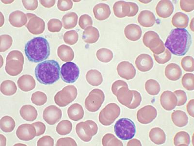 CLL Cells