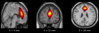 Images Shows Significant Difference between the High and Low Impact Youth Football Players