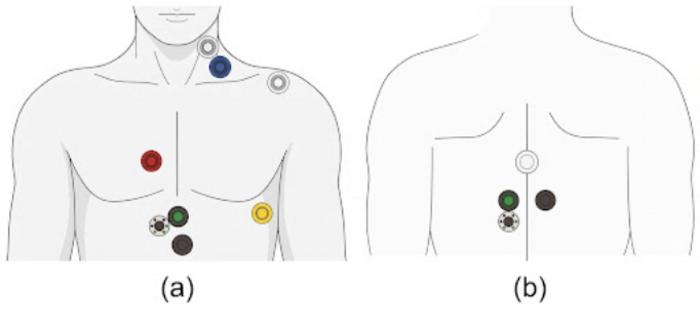 Adhesive sensors used by AI to predict cardiac index