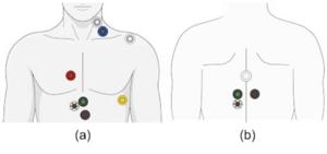 Adhesive sensors used by AI to predict cardiac index