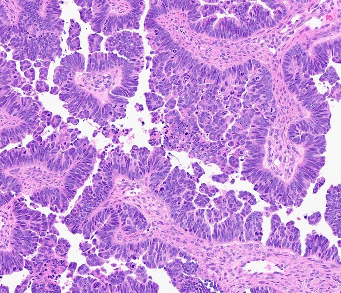 high grade serous carcinoma
