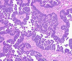 high grade serous carcinoma