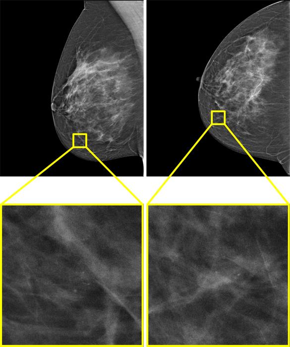 Example of a screening examination with a screen-detected cancer that would have been missed by AI