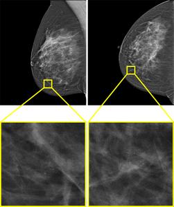 Example of a screening examination with a screen-detected cancer that would have been missed by AI