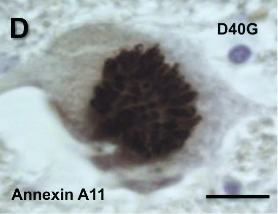 A Link Between Newly Identified Rare Mutations and Amyotrophic Lateral Sclerosis (3 of 4)