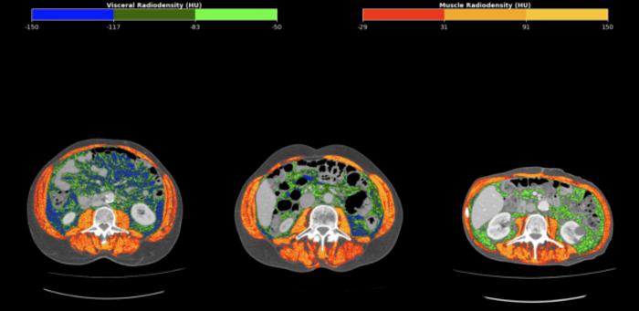 Unprecedented marker uses tomography to refine gastric cancer prognosis