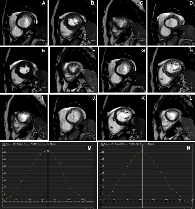 Representative images of participants with difficulty with breath holding and arrhythmia