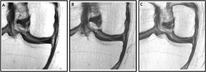 Knee MRI scans in a 57-year-old male participant in the Osteoarthritis Initiative who was administered a hyaluronic acid injection.