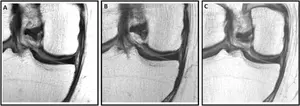 Knee MRI scans in a 57-year-old male participant in the Osteoarthritis Initiative who was administered a hyaluronic acid injection.