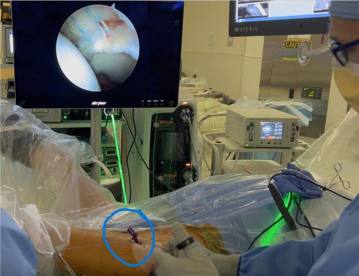 CAP-LIFT surgical use